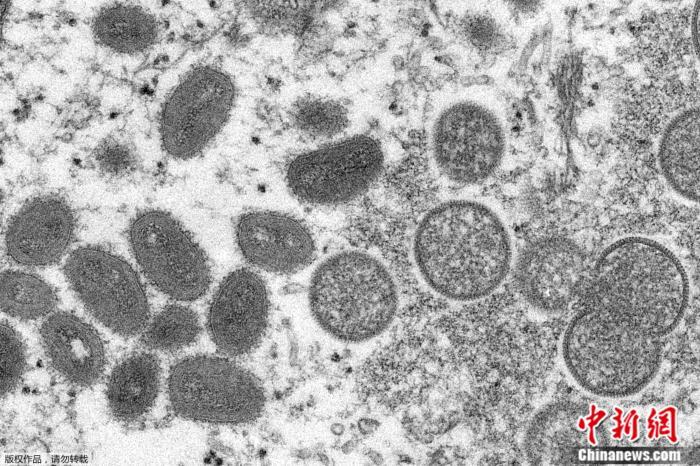 法国确诊33例猴痘病例 卫生部门呼吁民众提高警惕